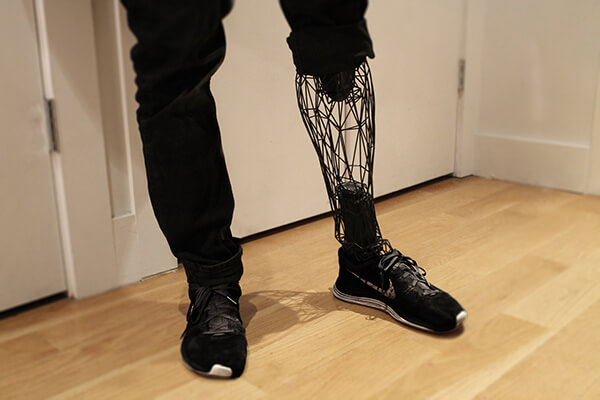 3d printed prosthesis